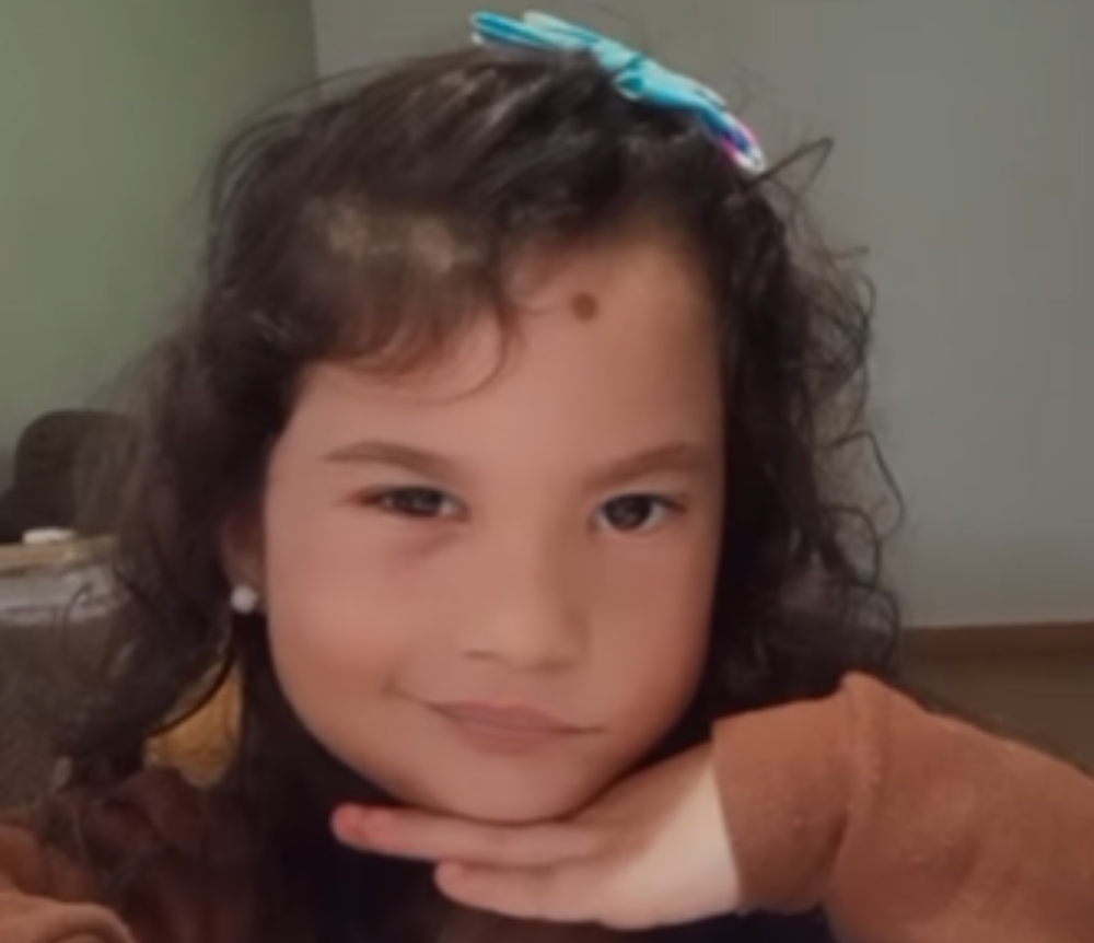 cirurgia paralisia facial