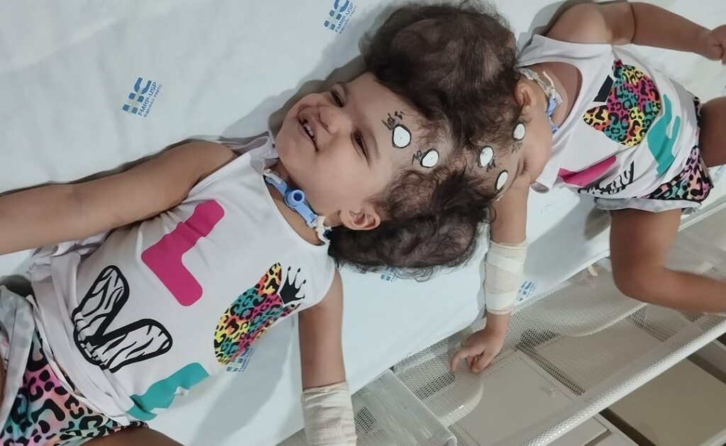 gemeas siamesas, ribeirão preto, cirurgia